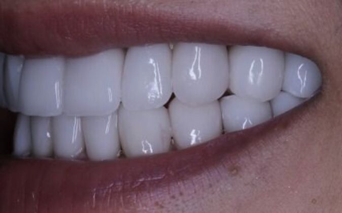 Full Mouth Reconstruction: Risa - After