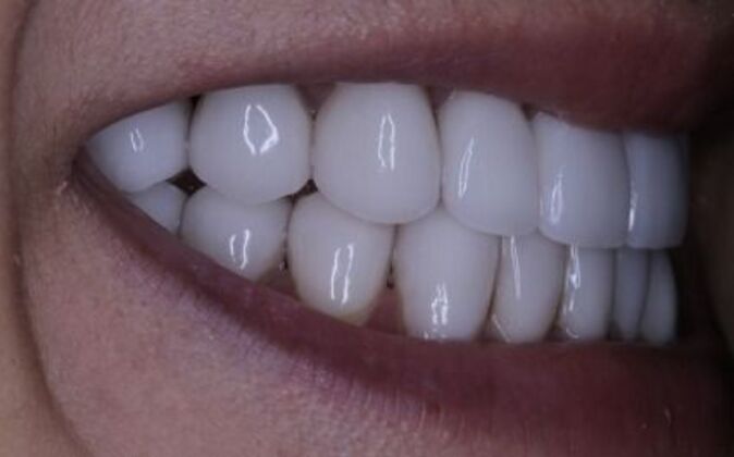 Full Mouth Reconstruction: Risa - After