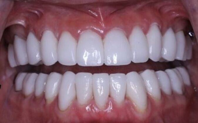 Full Mouth Reconstruction: Risa - Before