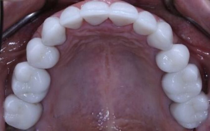 Full Mouth Reconstruction: Risa - After