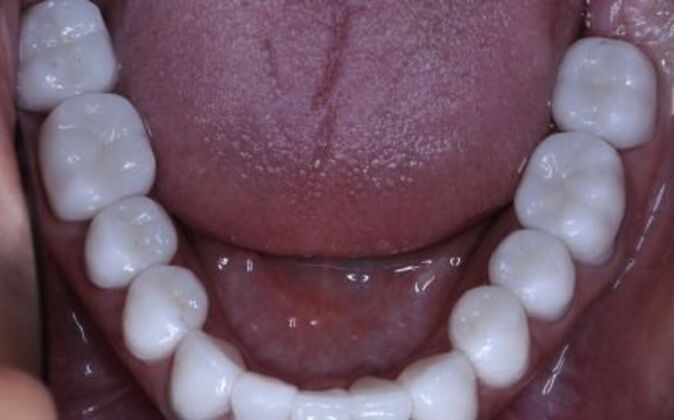 Full Mouth Reconstruction: Risa - After