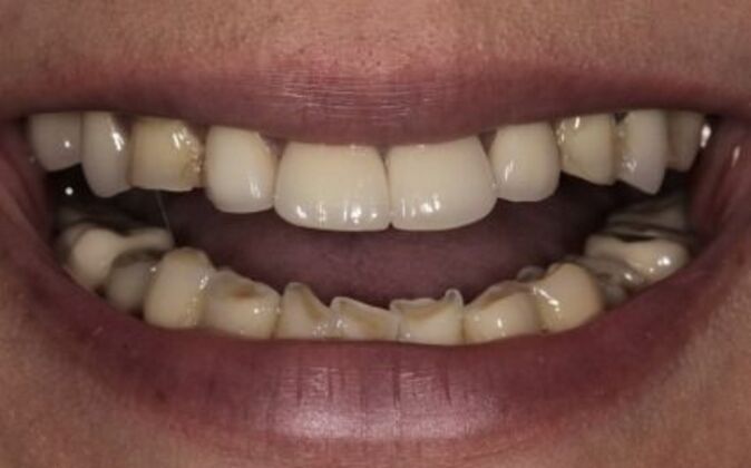 Full Mouth Reconstruction Risa - Before