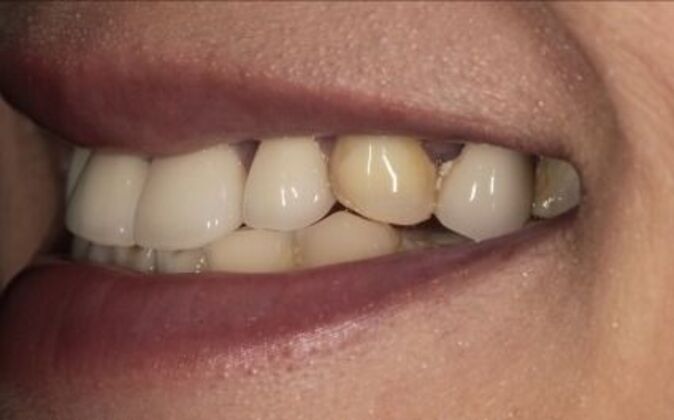 Full Mouth Reconstruction: Risa - Before