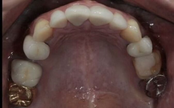 Full Mouth Reconstruction: Risa - Before