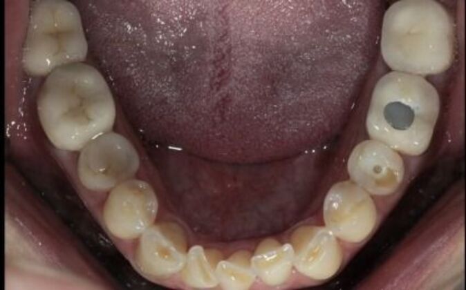 Full Mouth Reconstruction: Risa - Before