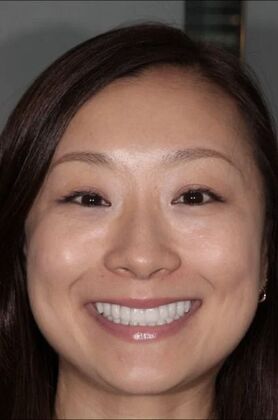 Full Mouth Reconstruction: Risa - After