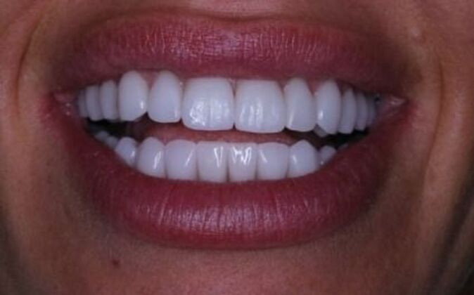 Full Mouth Reconstruction Piret - After