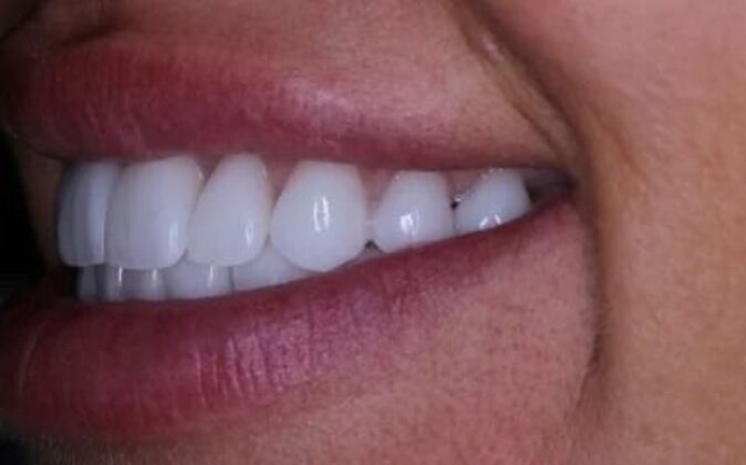 Full Mouth Reconstruction: Piret - After