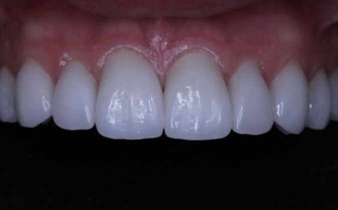 Full Mouth Reconstruction: Piret - After