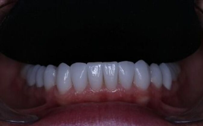 Full Mouth Reconstruction: Piret - After