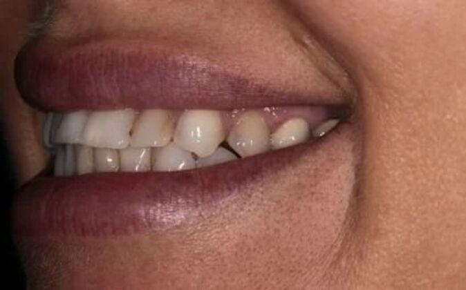 Full Mouth Reconstruction: Piret - Before