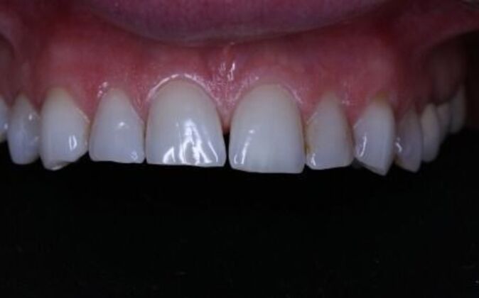 Full Mouth Reconstruction: Piret - Before