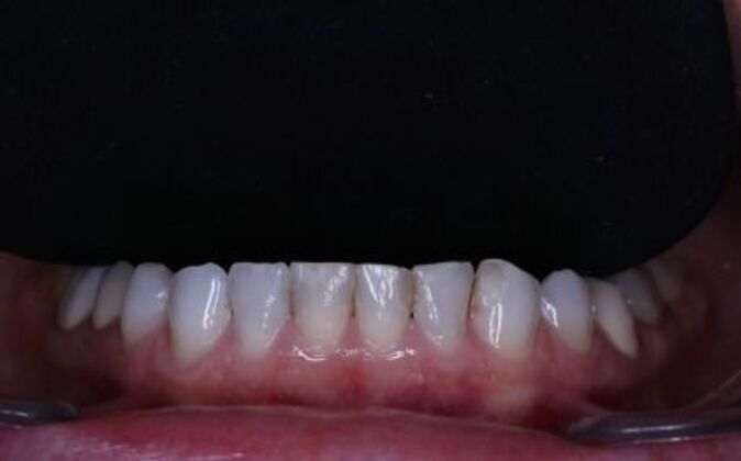 Full Mouth Reconstruction: Piret - Before