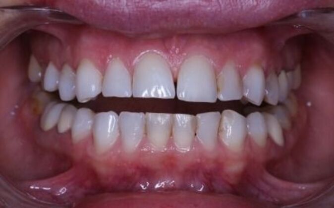 Full Mouth Reconstruction: Piret - Before