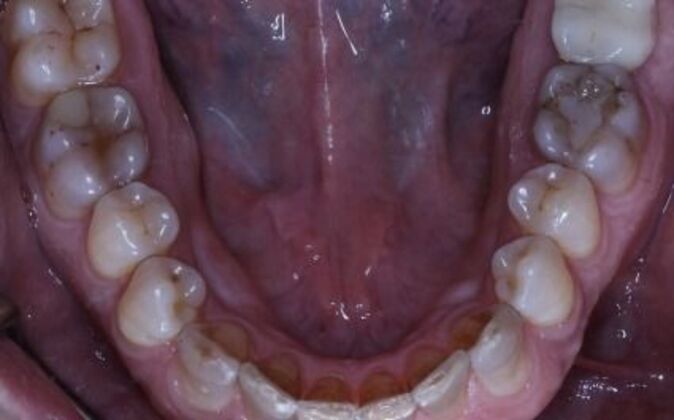 Full Mouth Reconstruction: Ted - Before