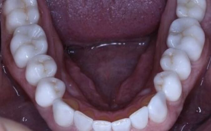 Full Mouth Reconstruction: Ted - After