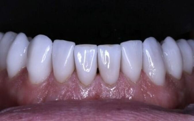 Full Mouth Reconstruction: Ted - After