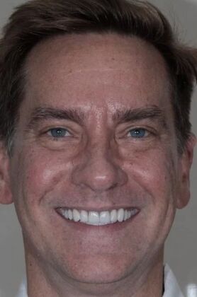 Full Mouth Reconstruction: Ted - After