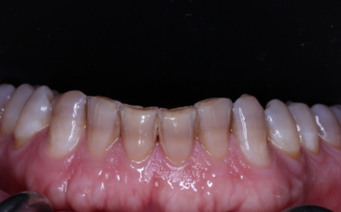 Full Mouth Reconstruction: Ted - Before