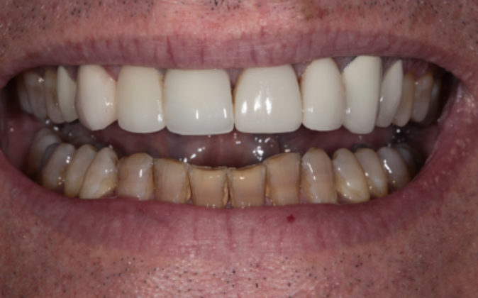 Full Mouth Reconstruction: Ted - Before