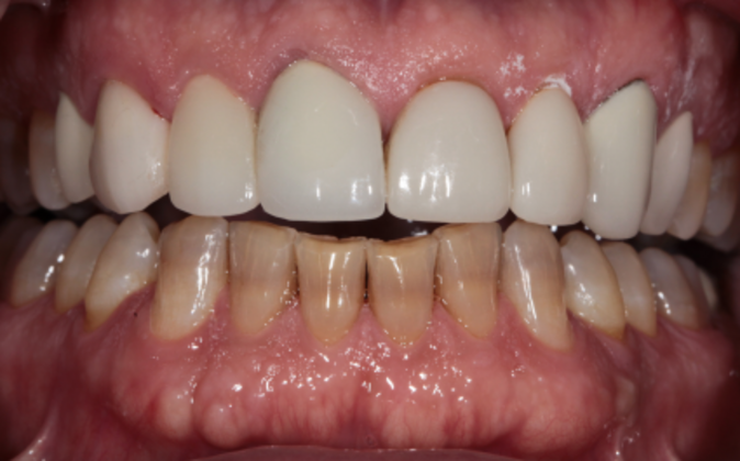 Full Mouth Reconstruction Ted - Before