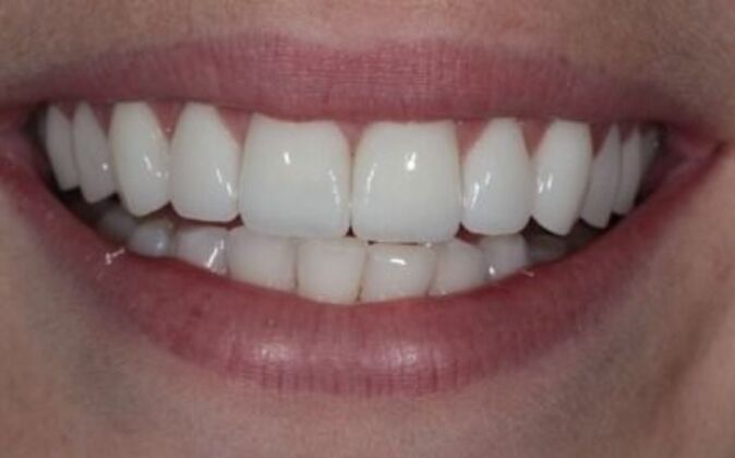 Veneers Stephanie - After
