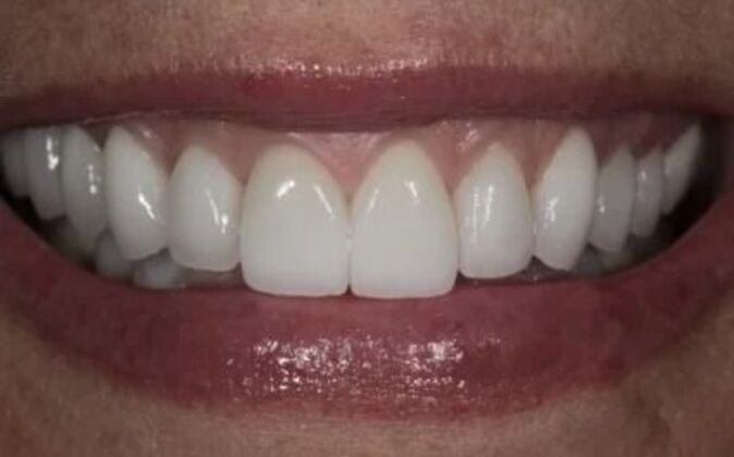 Veneers Shawna - After