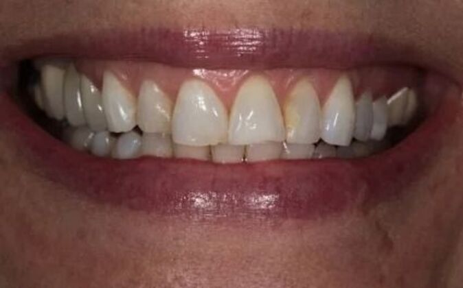 Veneers Shawna - Before
