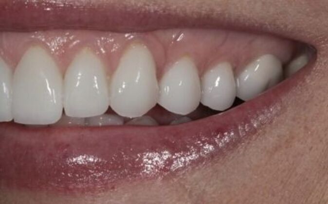 Veneers: Shawna - After