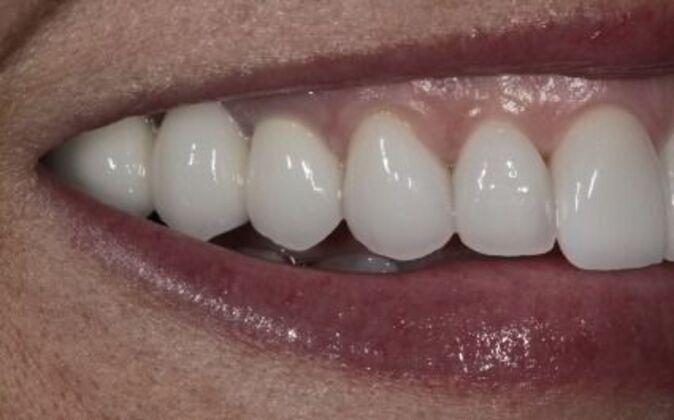 Veneers: Shawna - After