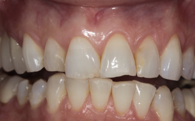 Veneers: Shawna - Before