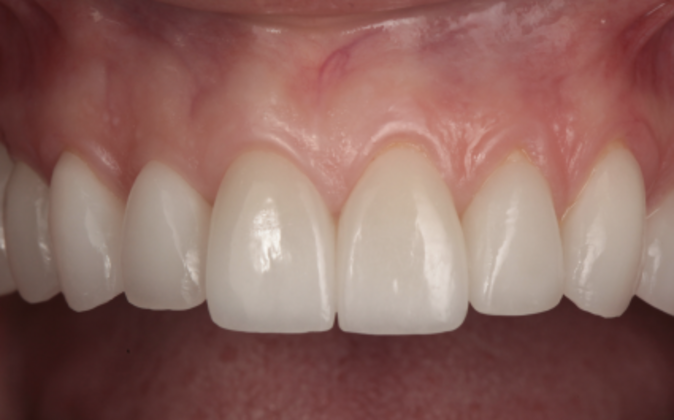 Veneers: Shawna - After