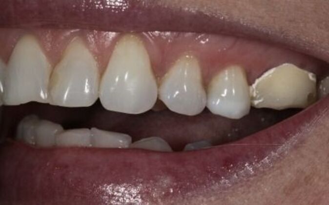 Veneers: Shawna - Before