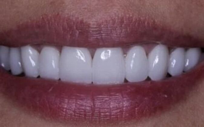Veneers Katie - After