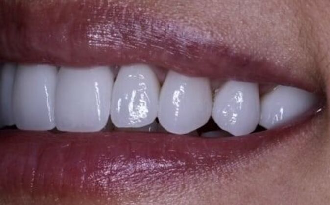 Veneers: Katie - After