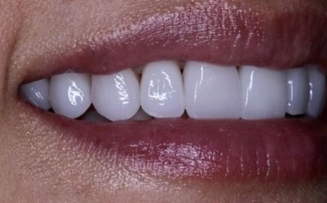 Veneers: Katie - After