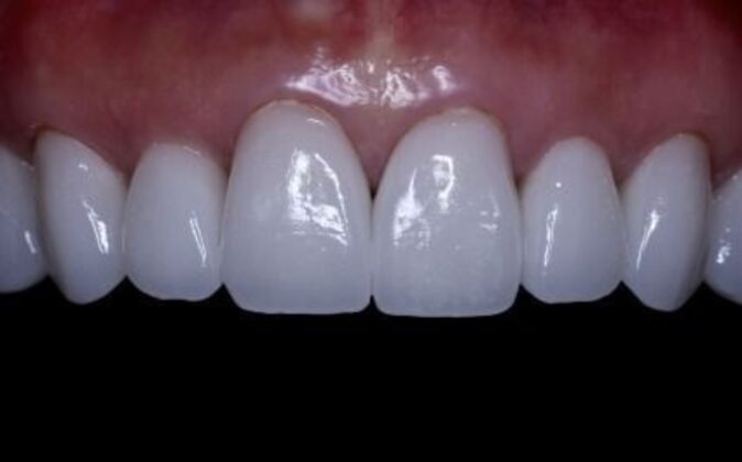 Veneers: Katie - After