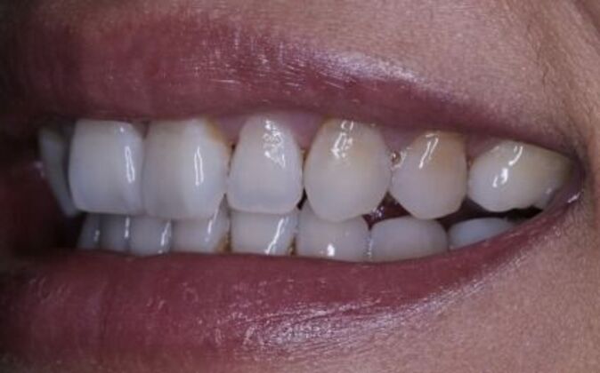 Veneers: Katie - Before