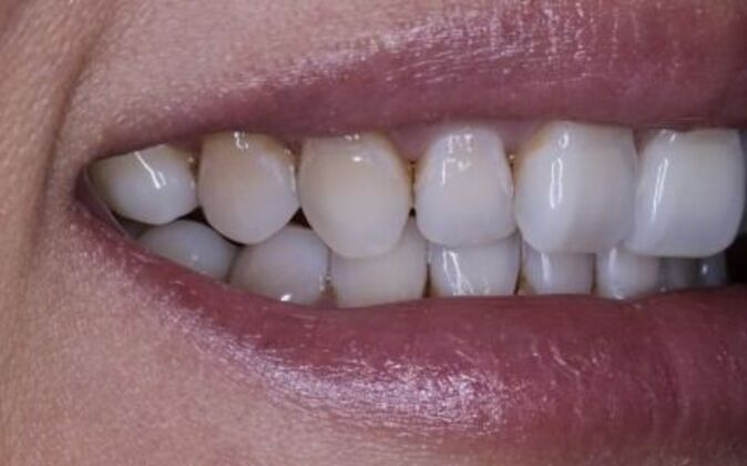 Veneers: Katie - Before