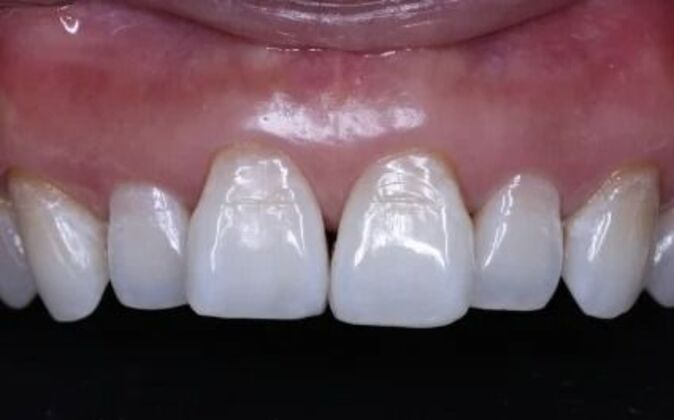 Veneers: Katie - Before