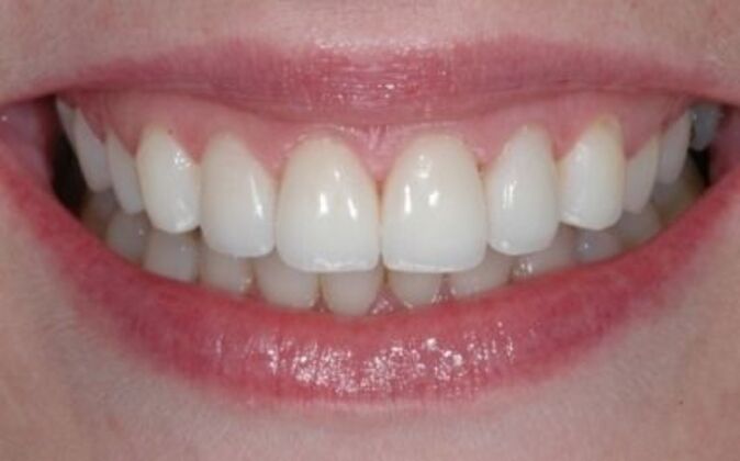 Veneers Hana - After