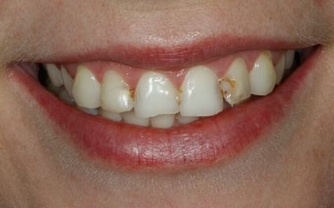 Veneers Hana - Before