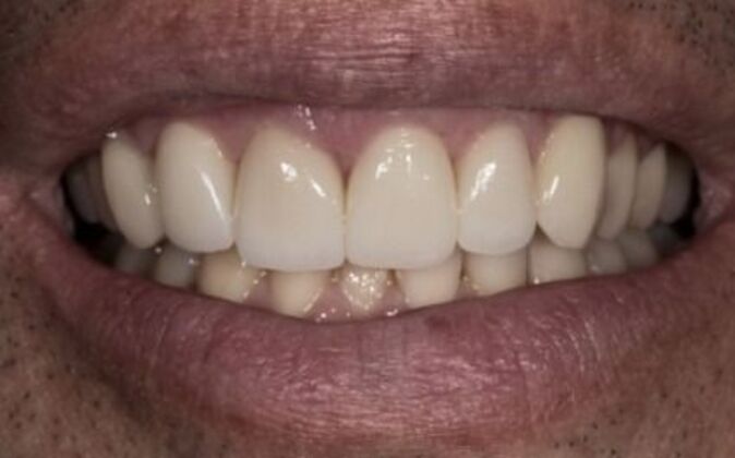 Smile Makeover Cases