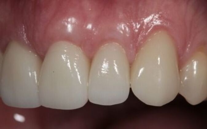 Smile Makeover: Andre - After