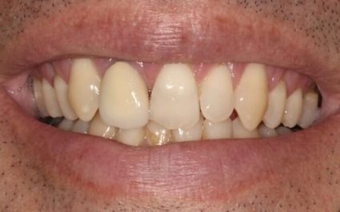 Smile Makeover Andre - Before