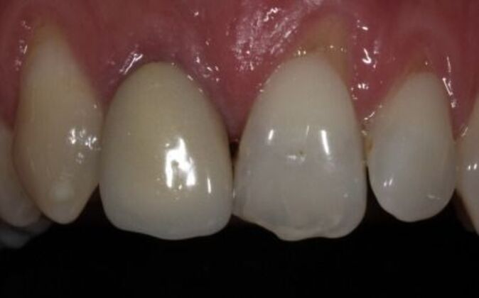 Smile Makeover: Andre - Before