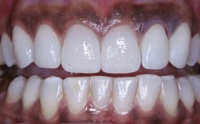 Veneers Tiara - After