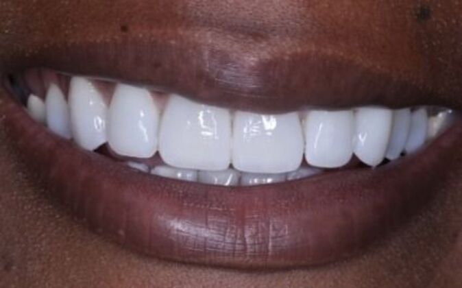 Veneers: Tiara - After
