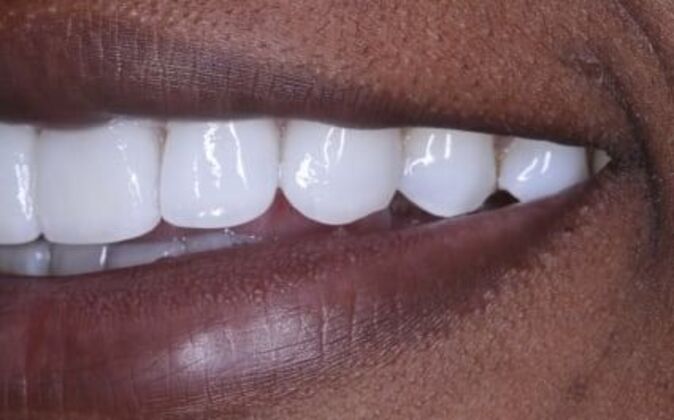Veneers: Tiara - After