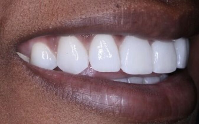 Veneers: Tiara - After